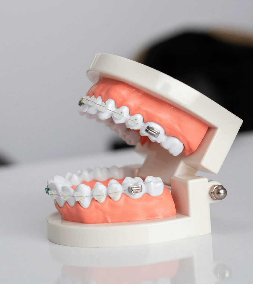Modelo de dientes con brackets