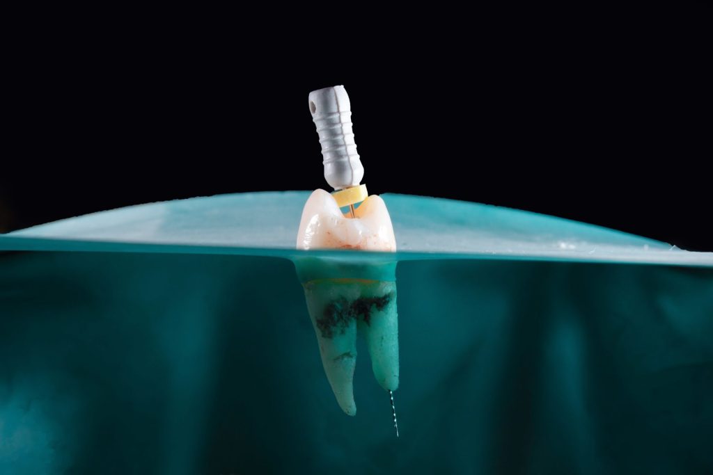Implante dental en cirugía oral